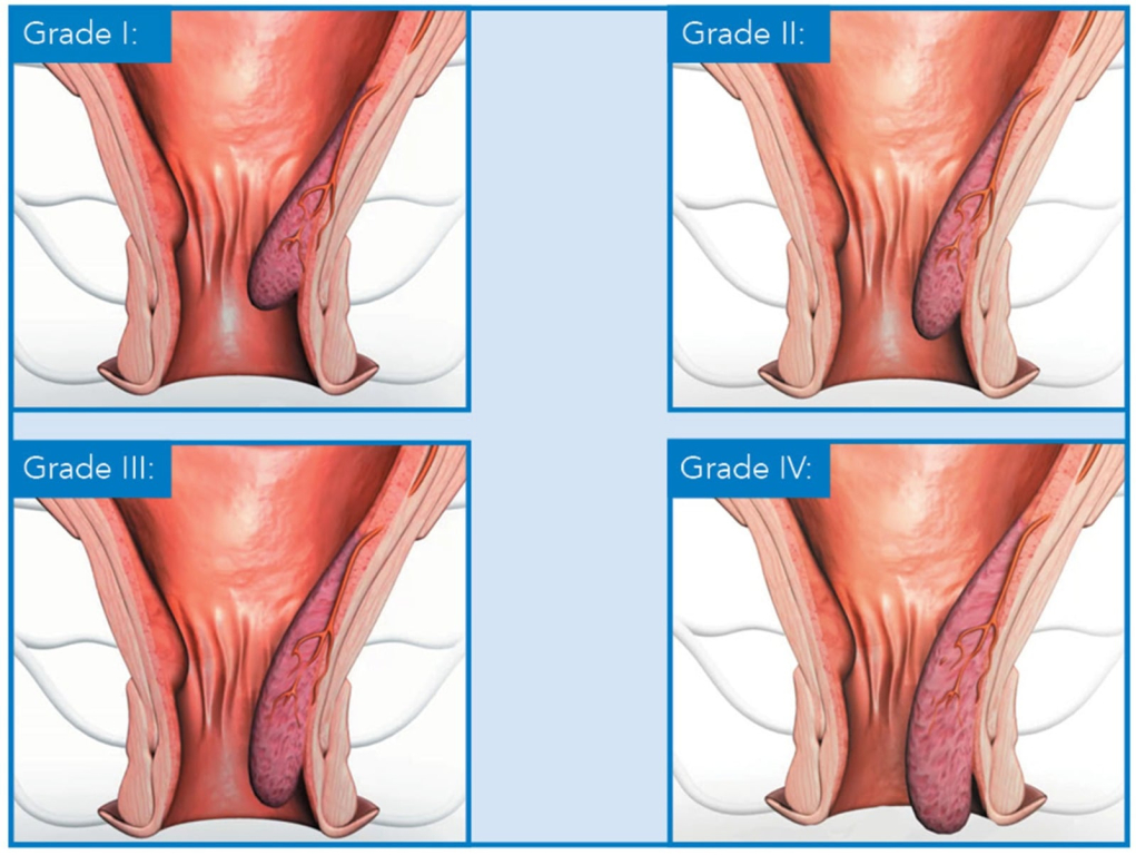 Hemoroīdu stadijas